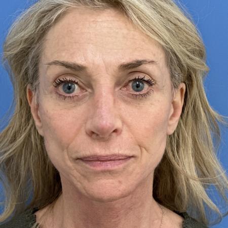 After image 1 Case #118306 - Facelift