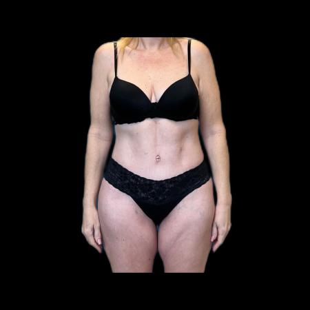 After image 1 Case #118136 - Pos-Bariatric
