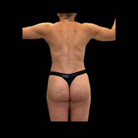 After Case #118236 - LipoEsculture and Gluteal Fat Grafting 