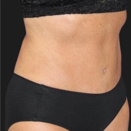 After image 3 Case #119271 - Mid 60s Patient | Menopause Makeover