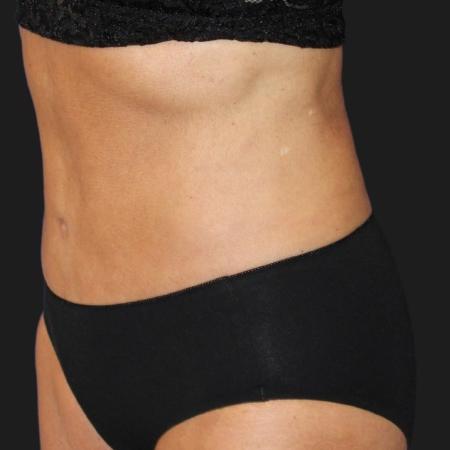 After image 2 Case #119271 - Mid 60s Patient | Menopause Makeover