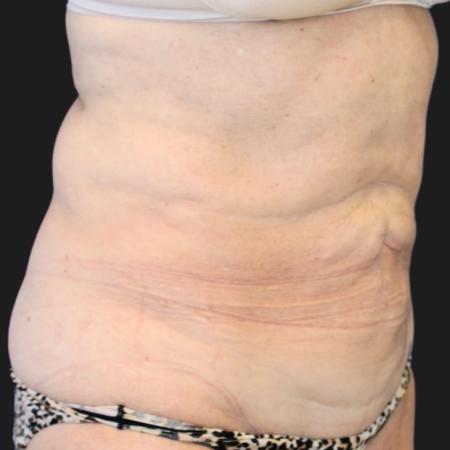 Before image 3 Case #119271 - Mid 60s Patient | Menopause Makeover