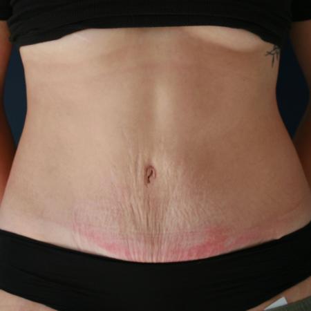 After image 1 Case #119241 - Tummy Tuck (Abdominoplasty)