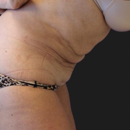 Before image 4 Case #119271 - Mid 60s Patient | Menopause Makeover