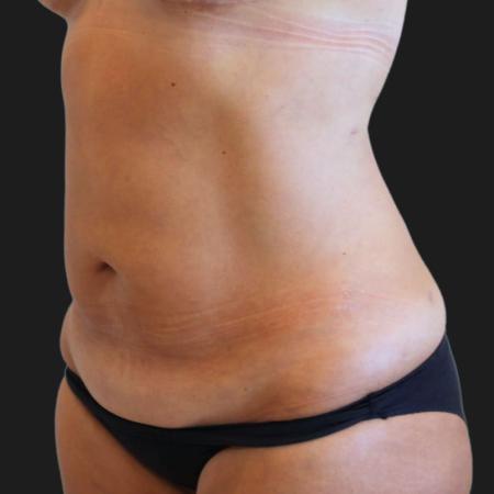 Before image 3 Case #119276 - 48 year-old Patient | Tummy Tuck