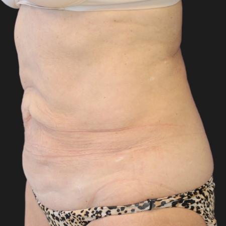 Before image 2 Case #119271 - Mid 60s Patient | Menopause Makeover