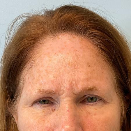 Before image 1 Case #119701 - Botox Injections