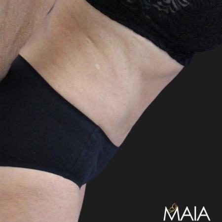 After image 4 Case #119271 - Mid 60s Patient | Menopause Makeover