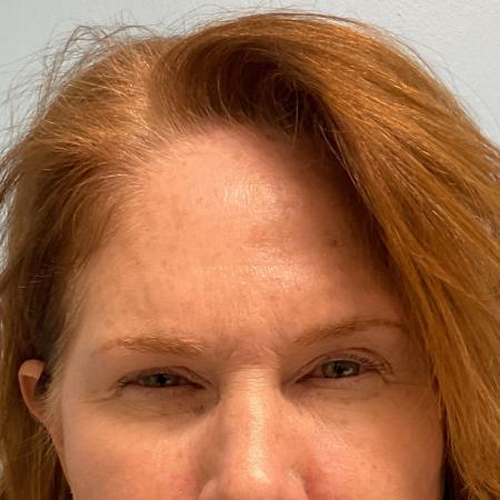 After image 1 Case #119701 - Botox Injections