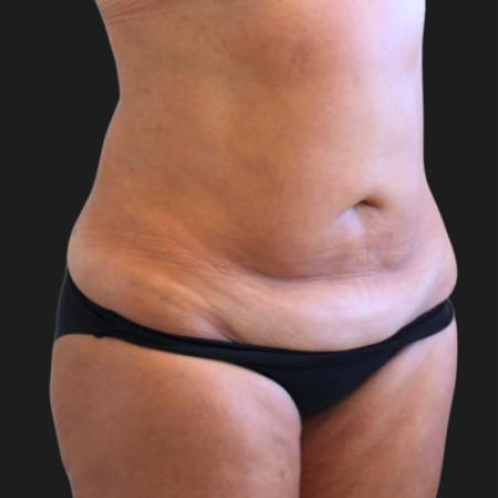 Before image 2 Case #119276 - 48 year-old Patient | Tummy Tuck