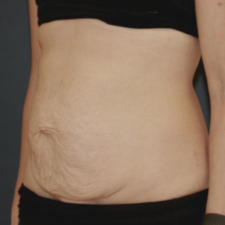 Before image 2 Case #119241 - Tummy Tuck (Abdominoplasty)