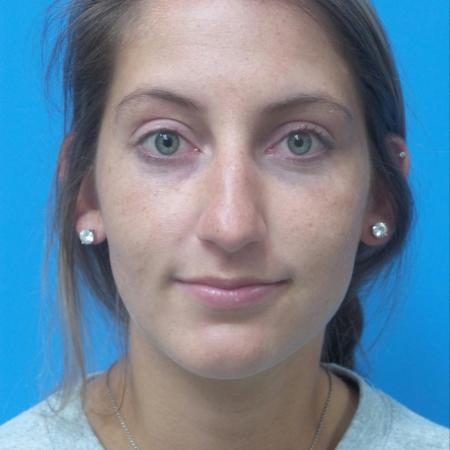 Before image 1 Case #121321 -   Open Rhinoplasty - 2 year post-op