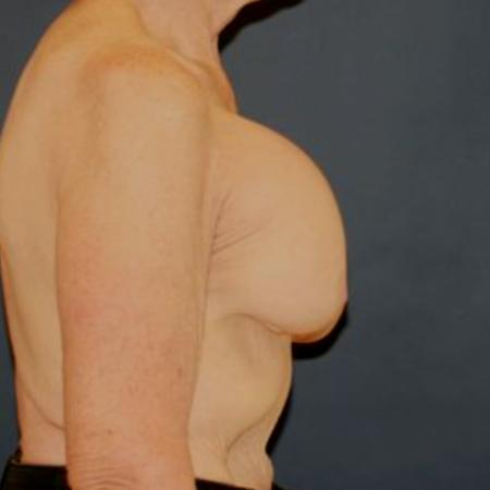 Before image 3 Case #121931 - Breast Revision