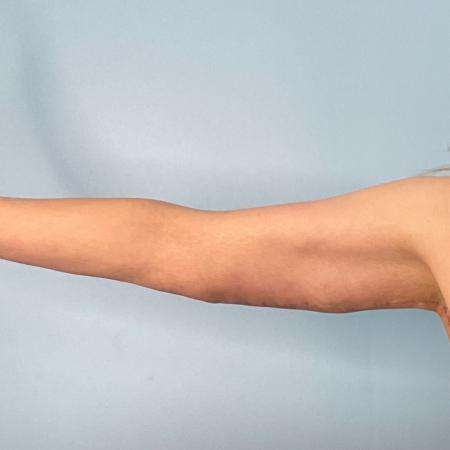 After Case #120891 - 42 year old female with Brachioplasty