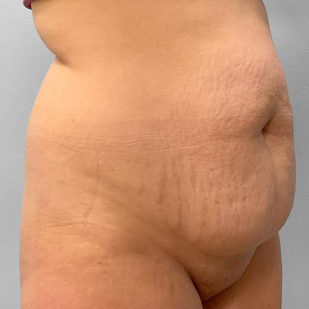 Before image 2 Case #120861 - Abdominoplasty & Liposuction