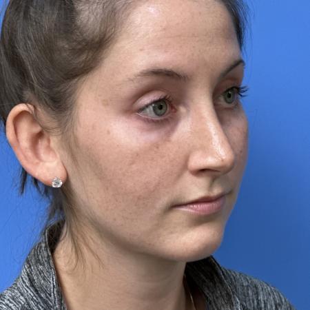 After image 2 Case #121321 -   Open Rhinoplasty - 2 year post-op