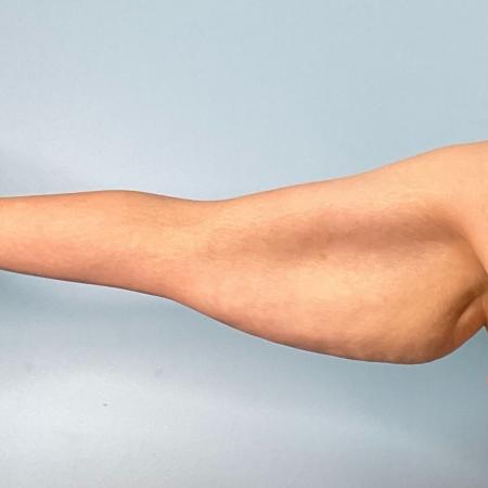 Before Case #120891 - 42 year old female with Brachioplasty