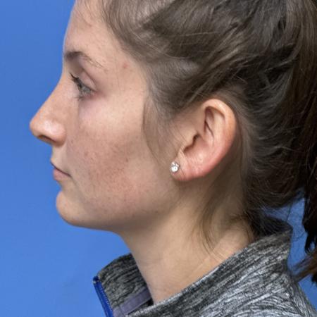 After image 3 Case #121321 -   Open Rhinoplasty - 2 year post-op