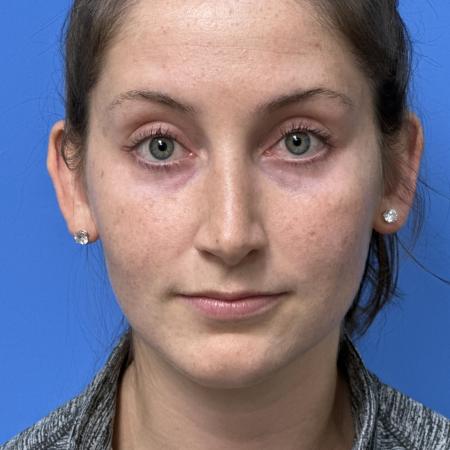 After image 1 Case #121321 -   Open Rhinoplasty - 2 year post-op