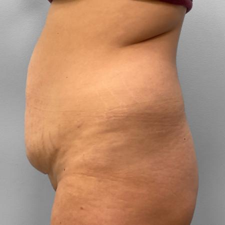 Before image 3 Case #120861 - Abdominoplasty & Liposuction