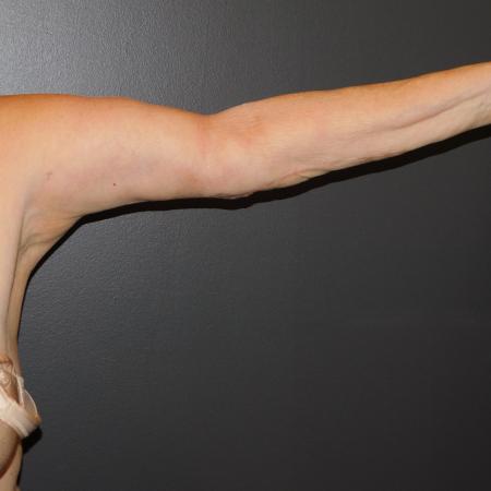 After image 1 Case #122361 - Brachioplasty with liposuction
