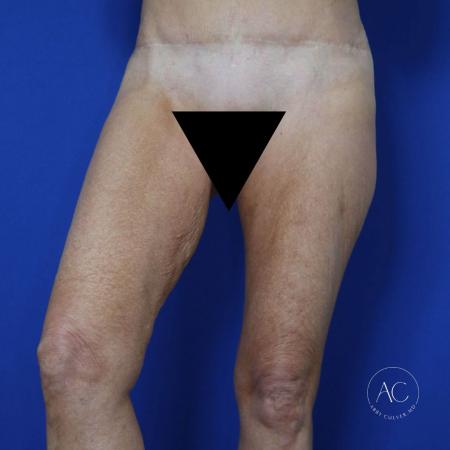 Before image 2 Case #122081 - Thighplasty with Liposuction