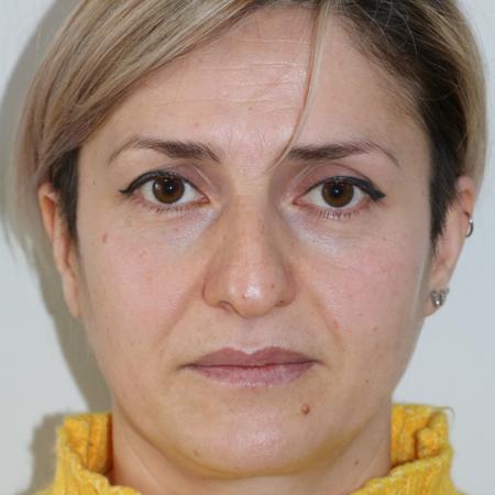 Before image 1 Case #122406 - Aesthetic Reduction Rhinoseptoplasty