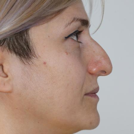 Before image 5 Case #122406 - Aesthetic Reduction Rhinoseptoplasty