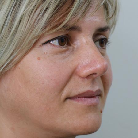 After image 3 Case #122406 - Aesthetic Reduction Rhinoseptoplasty