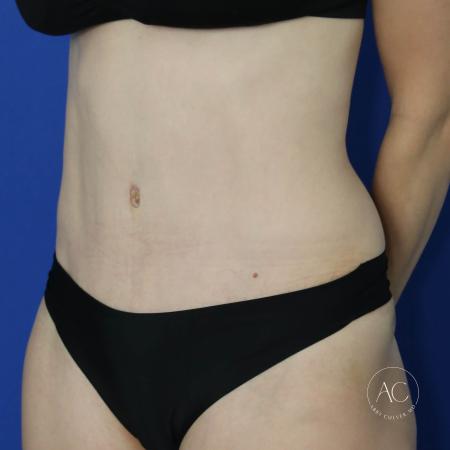 After image 2 Case #122076 - Abdominoplasty