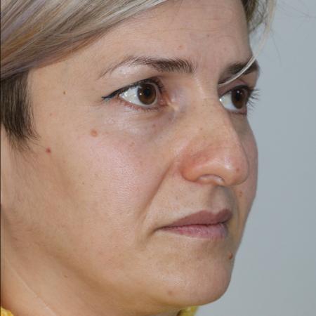 Before image 3 Case #122406 - Aesthetic Reduction Rhinoseptoplasty