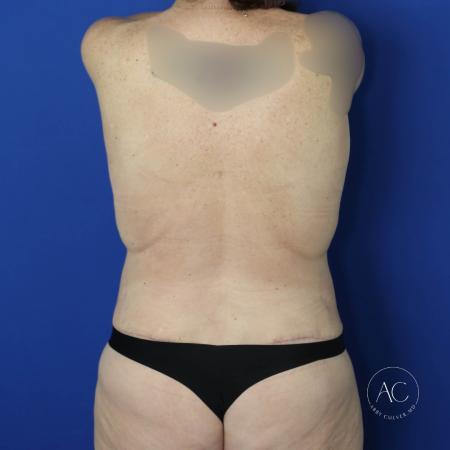 After image 5 Case #122101 - Abdominoplasty with Lipo and Breast Reduction/Lift