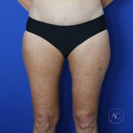 After image 1 Case #122081 - Thighplasty with Liposuction
