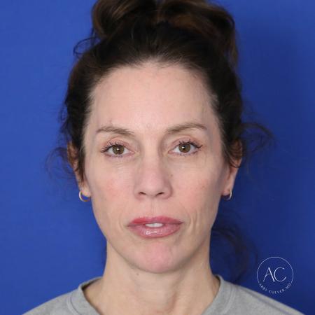 After image 1 Case #122096 - Facial Rejuvenation