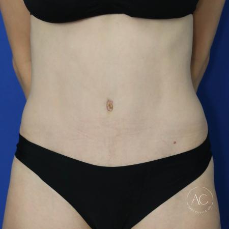 After image 1 Case #122076 - Abdominoplasty