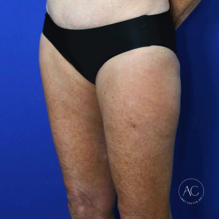 After image 3 Case #122081 - Thighplasty with Liposuction