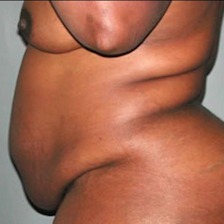 Before image 2 Case #122011 - Mommy Makeover Tummy Tuck 