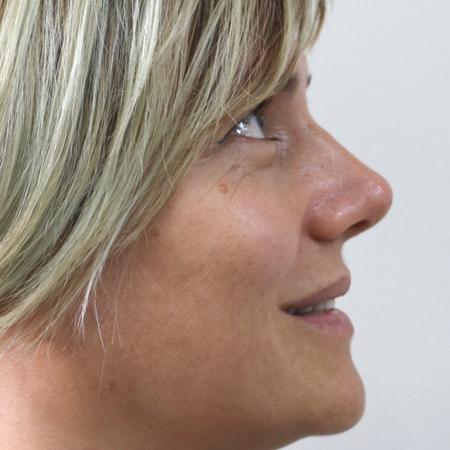 After image 5 Case #122406 - Aesthetic Reduction Rhinoseptoplasty