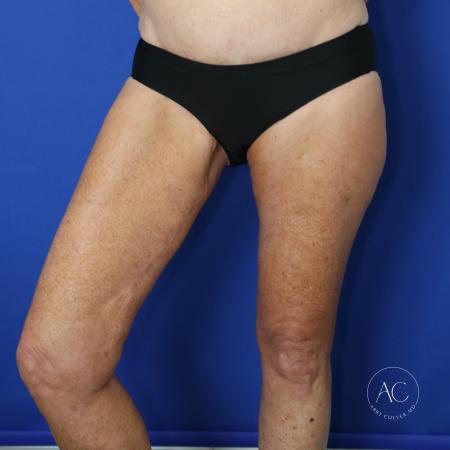 After image 2 Case #122081 - Thighplasty with Liposuction