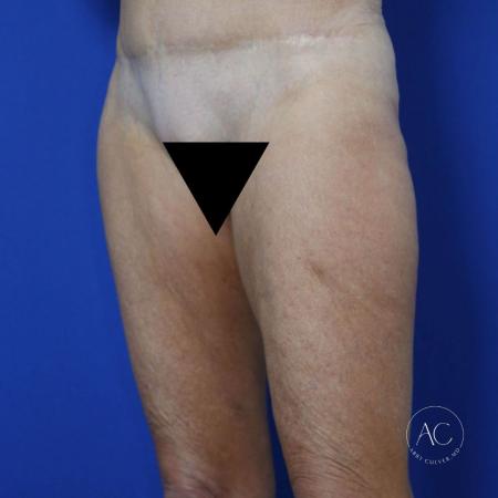Before image 3 Case #122081 - Thighplasty with Liposuction