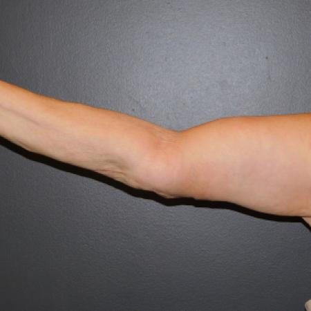 After image 2 Case #122361 - Brachioplasty with liposuction