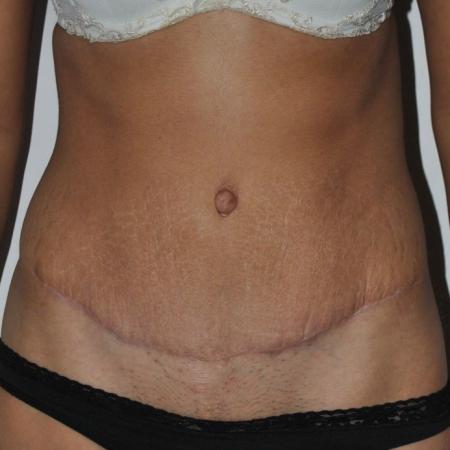 After image 1 Case #122716 - Abdominoplasty