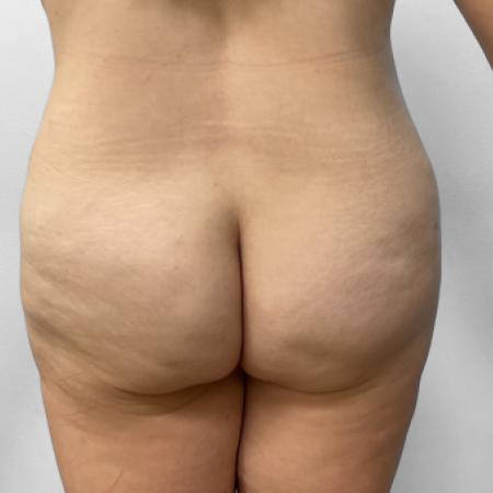 After image 4 Case #123236 - Tummy Tuck