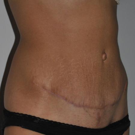After image 2 Case #122716 - Abdominoplasty