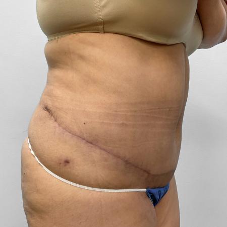 After image 2 Case #123196 - Tummy Tuck