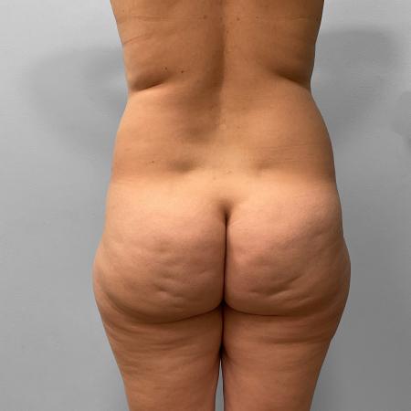 Before image 3 Case #123191 - Liposuction