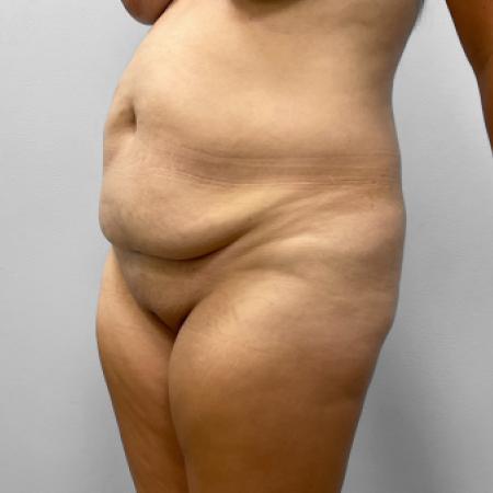 Before image 2 Case #123236 - Tummy Tuck