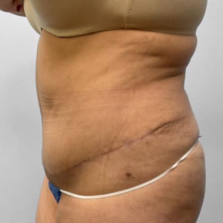 After image 3 Case #123196 - Tummy Tuck