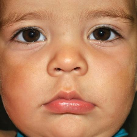 After image 1 Case #122871 - Congenital Vascular Malformation