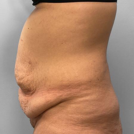 Before image 3 Case #123231 - Tummy Tuck